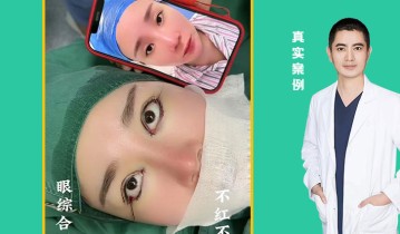 眼综合四项