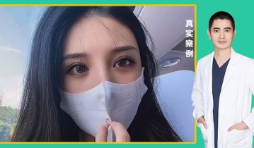 张书明医生-黄金媚眼重睑术效果