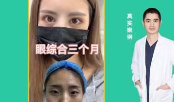 眼综合3个月效果